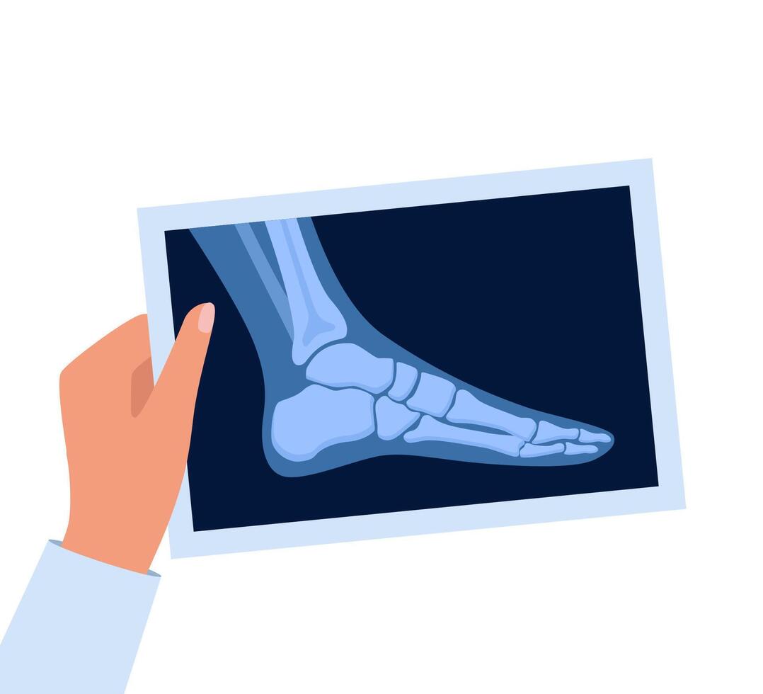 X ray human foot. X-ray picture or radiographic monitor image of metatarsus bones and toes. Medical radiology. Roentgen shot in doctors hand. vector