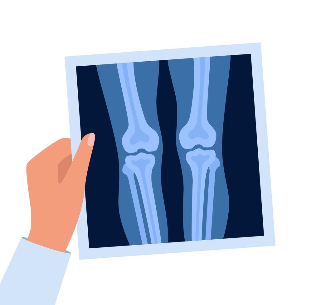 Xray of human knees bones and joints, examination and diagnosis. Roentgen shot in doctors hand. vector