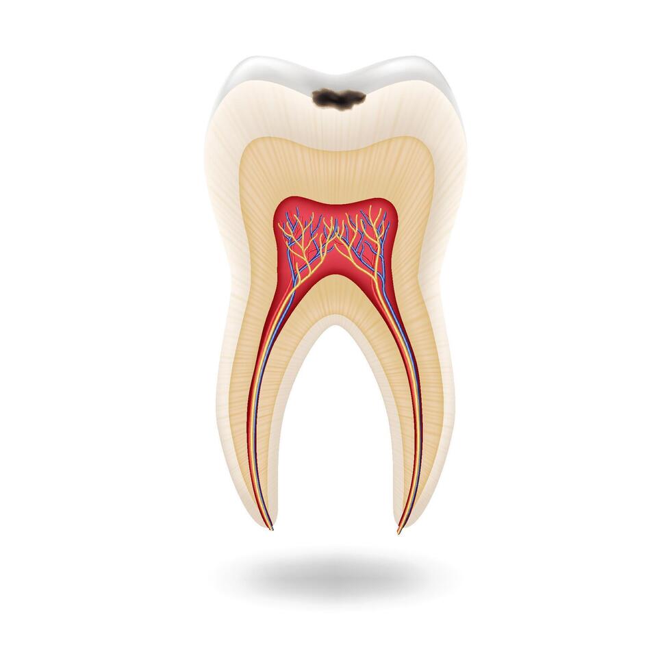 Illustration of human tooth structure showing cavity and nerves with detailed anatomy on white background for dental health education and awareness with copy space. vector
