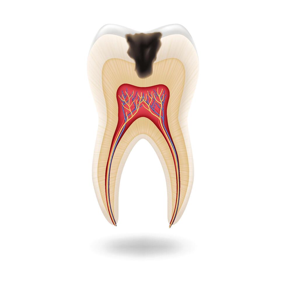 Detailed illustration of tooth anatomy showing decay in realistic style. Colors emphasize pulp and dentin with visual focus on decay. Educational tool for dentistry studies with copy space. vector