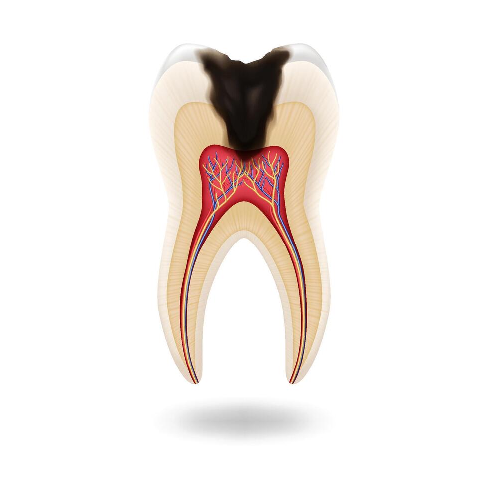 Illustration showing crosssection of tooth with decay and nerves visible, educational purpose, isolated on white background, dental health, with copy space vector