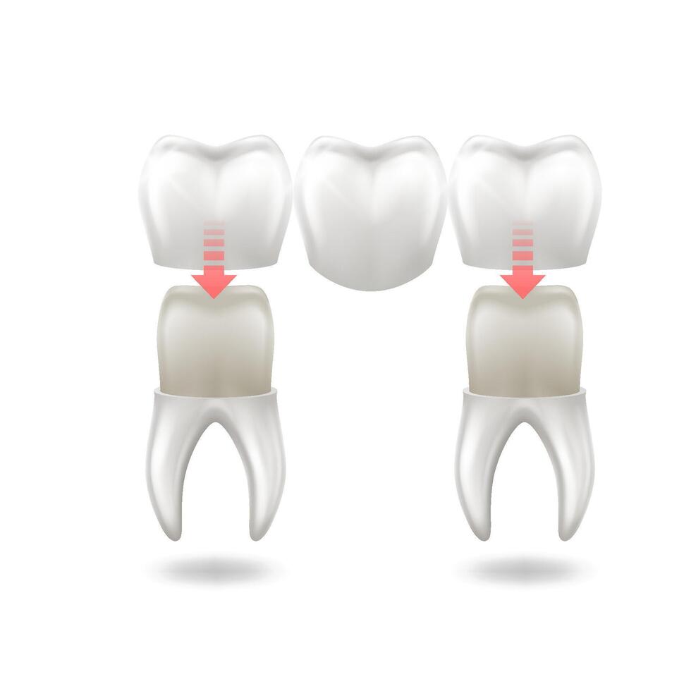 Dental procedure illustration showing crowns placed over teeth with arrows, enhancing patient understanding, on white background with copy space. Ideal for dental education materials. vector