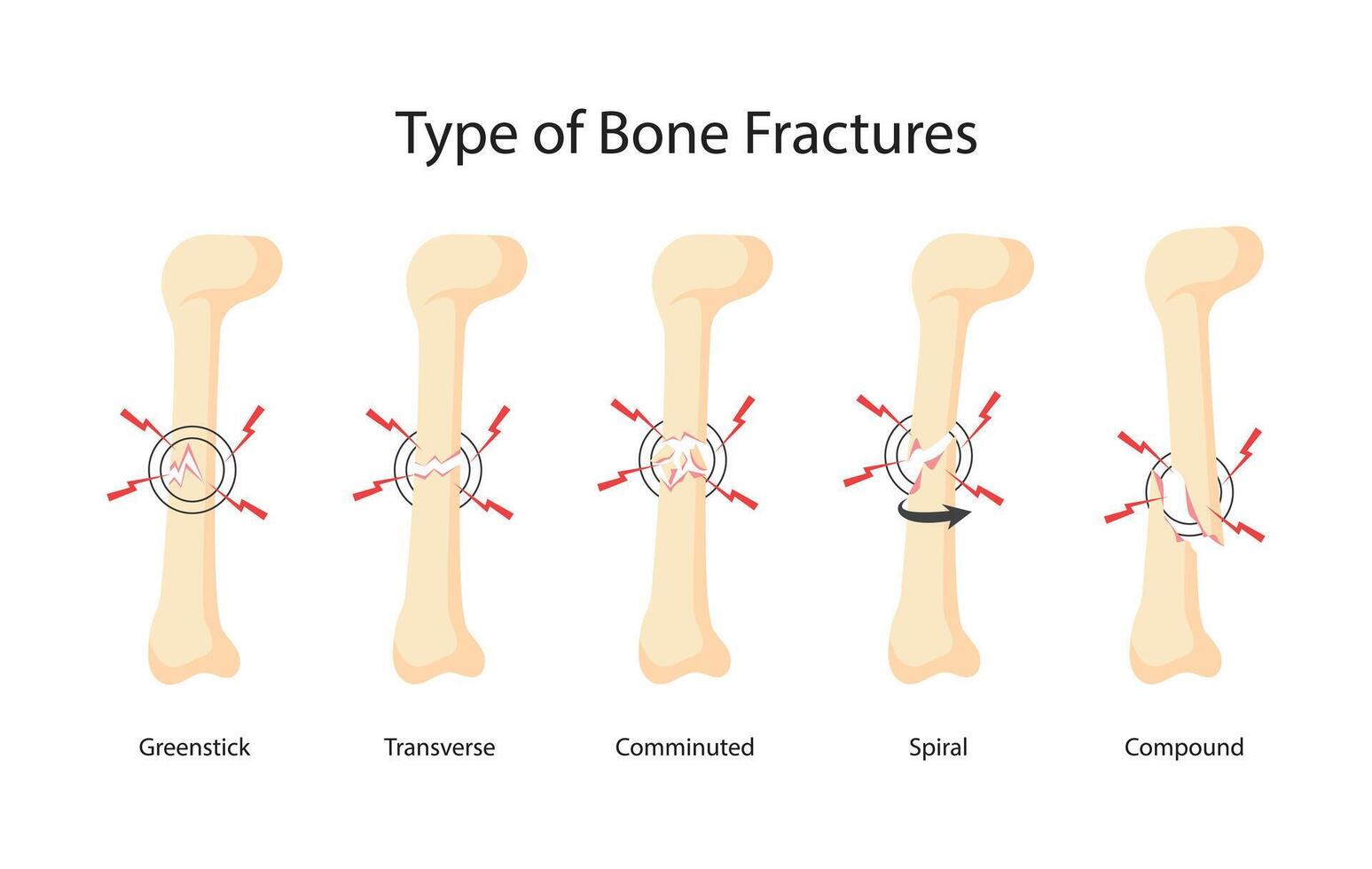 set of various bone fractures illustrations vector