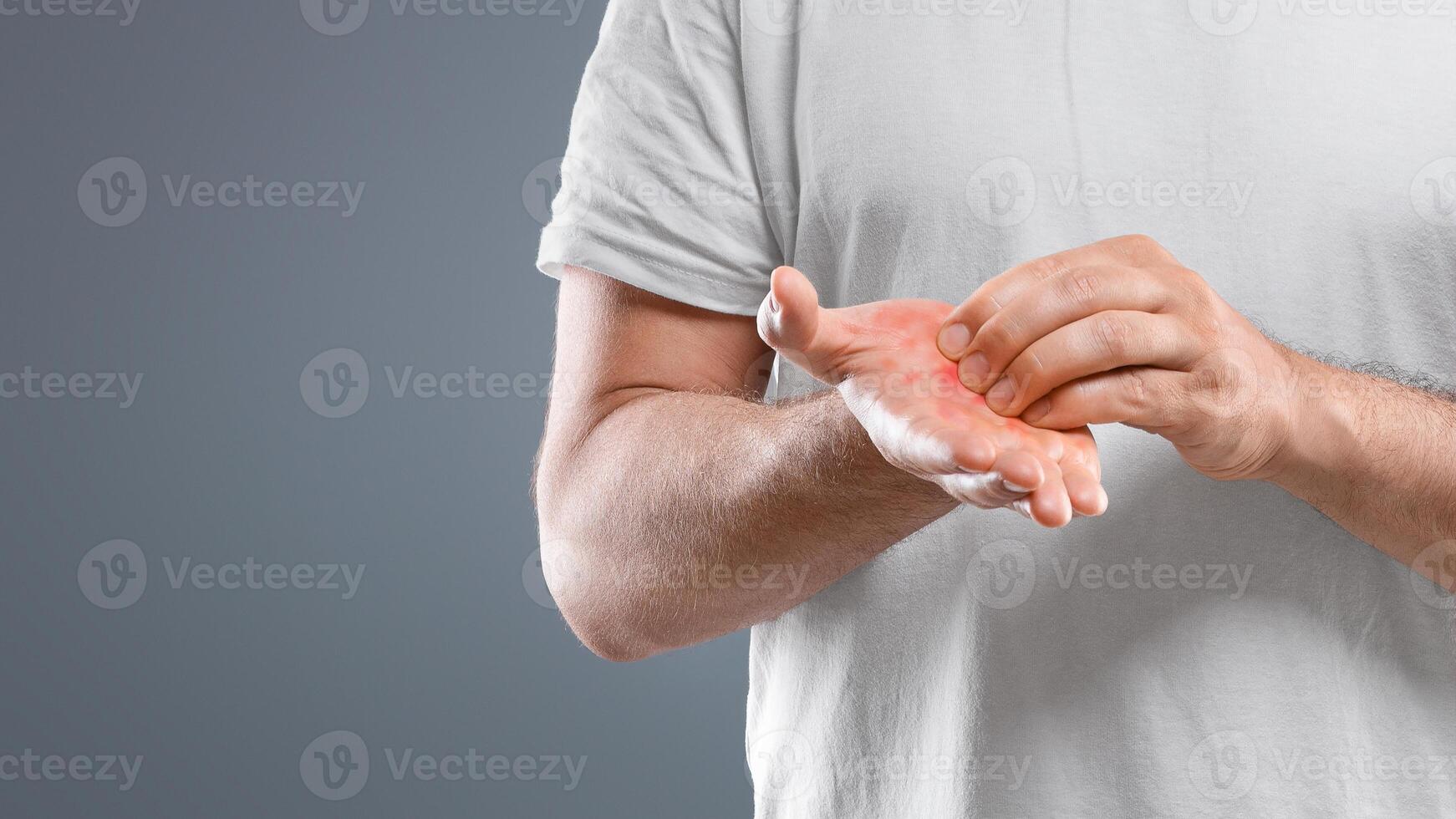 Annoyed middle aged bearded man scratching his red palm on grey studio background, copy space. Caucasian man suffering from allergic reaction, psoriasis or eczema, having itchy hands photo