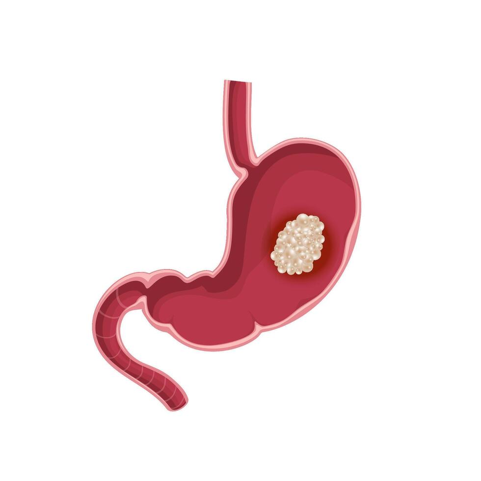 Stomach cancer. Cross section vector