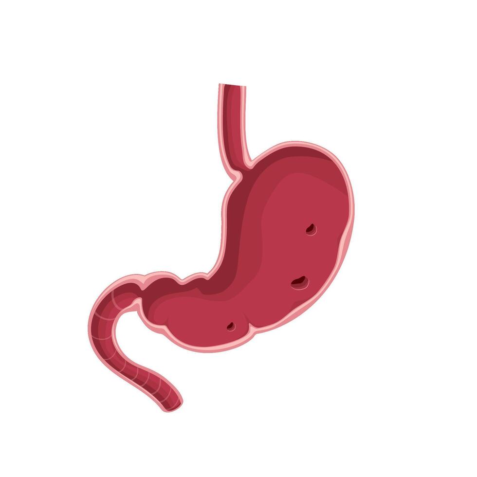 Stomach cross section, erosive gastritis vector