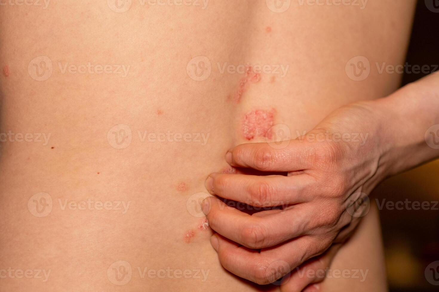psoriasis patches visible on the back with hand touching itchy areas in a close up view photo