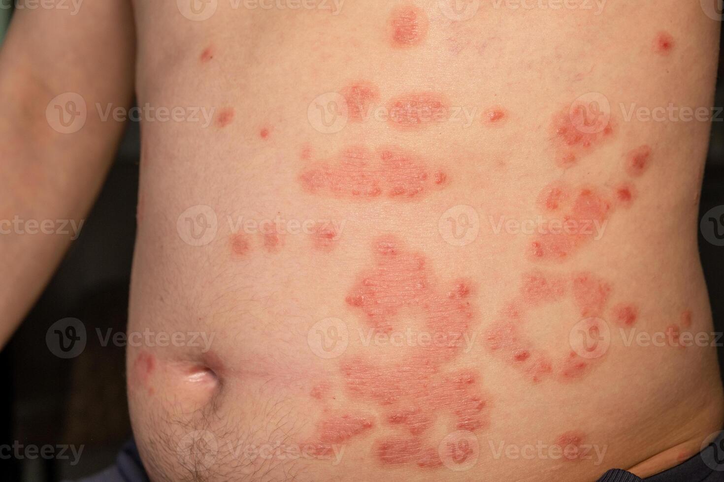 Red itchy patches on skin caused by psoriasis highlighting a common autoimmune skin condition photo