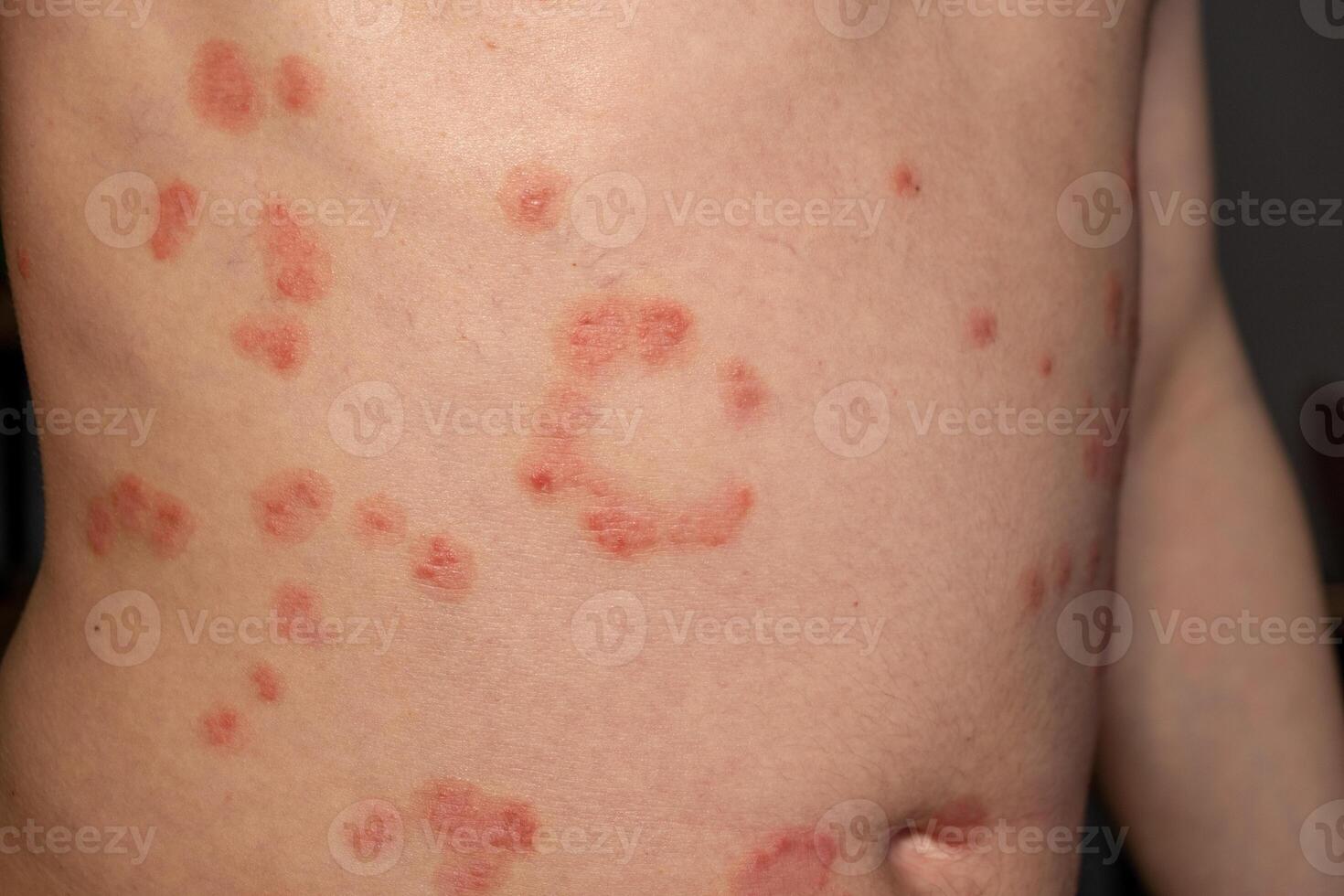 Skin patches reveal the symptoms of psoriasis on an individuals abdomen, demonstrating the effects of a chronic skin condition photo