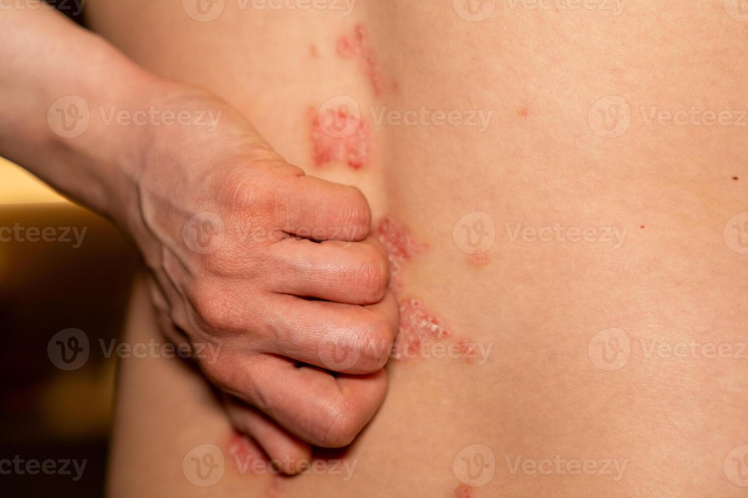 Symptoms of psoriasis visible on skin with red, itchy patches affecting the back area during indoor daylight hours photo