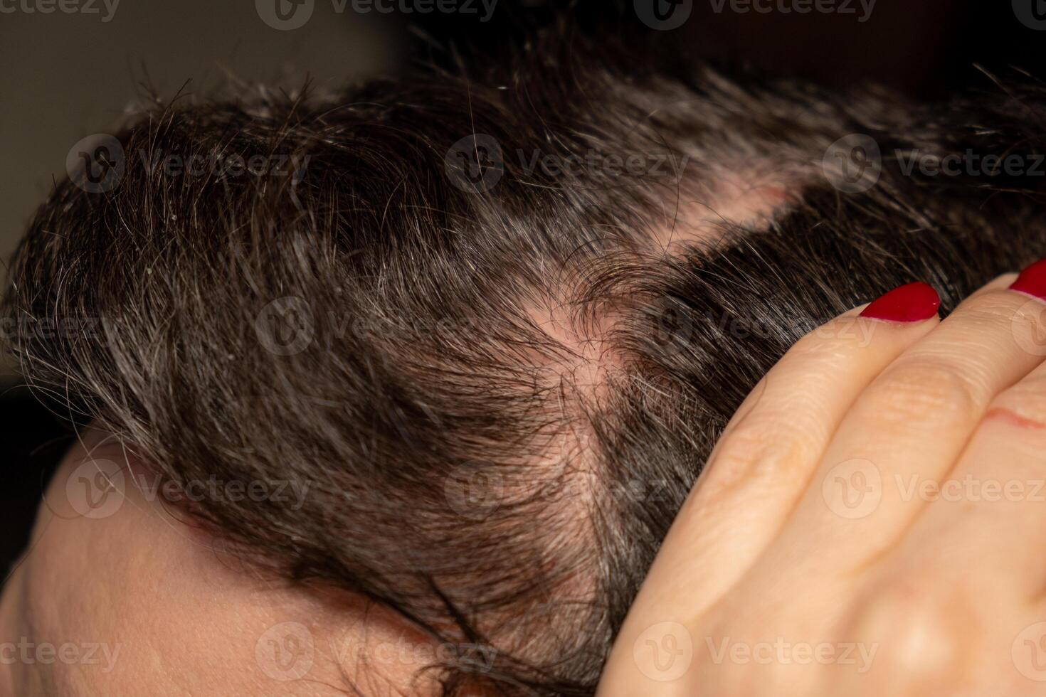 Scalp affected by psoriasis showing red patches and scaly skin in close up view photo
