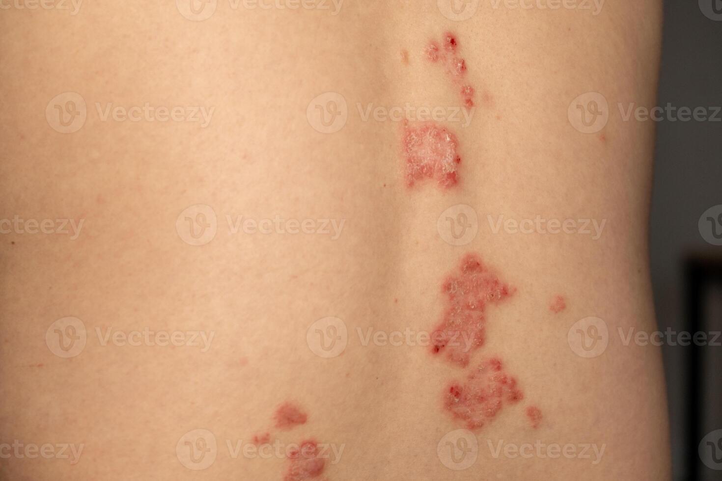 Skin patches reflect the challenges of living with psoriasis on the body surface photo