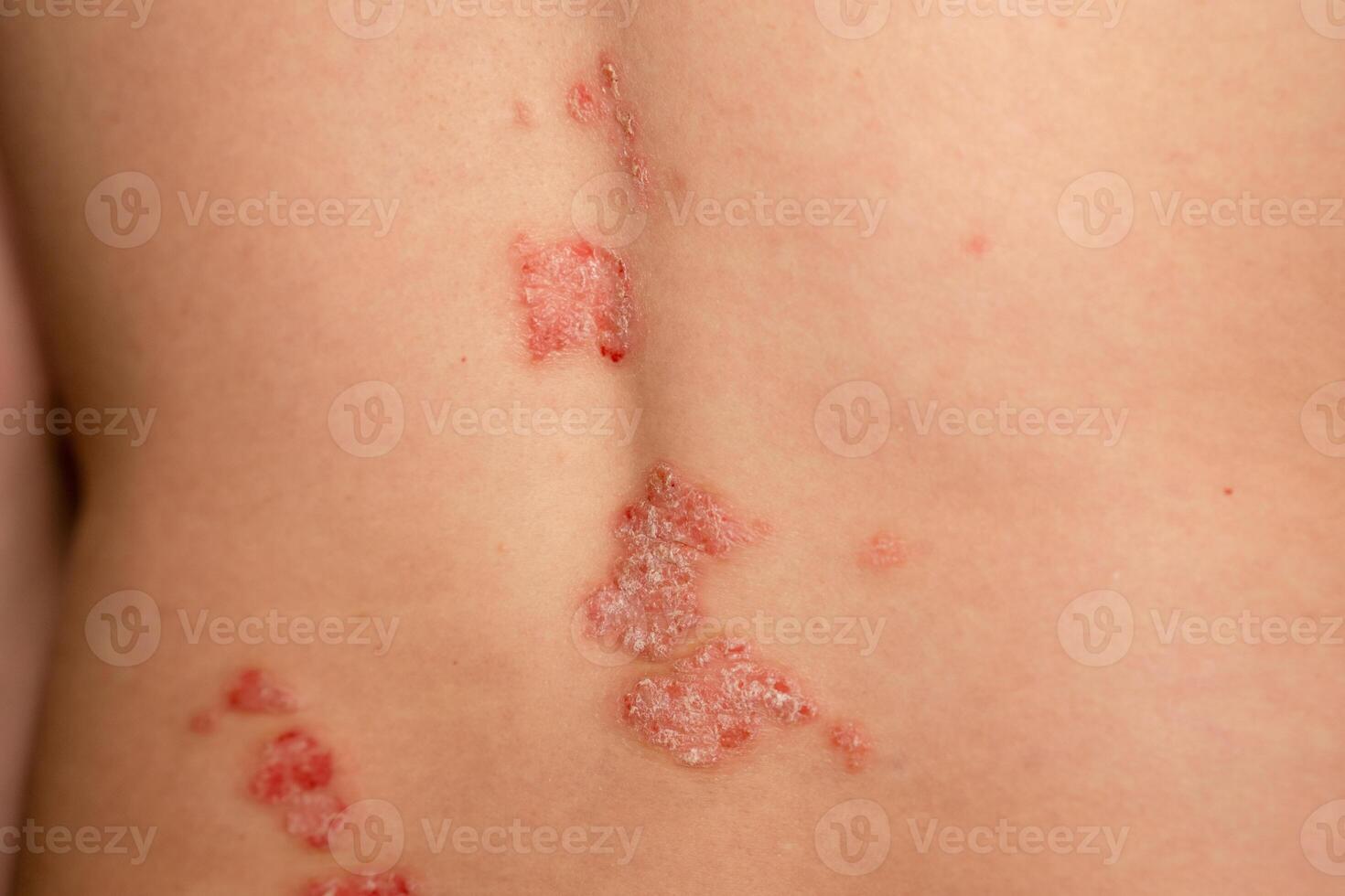 Psoriasis skin patches on a persons back showing red, itchy, and scaly spots indicative of this genetic immune disease photo