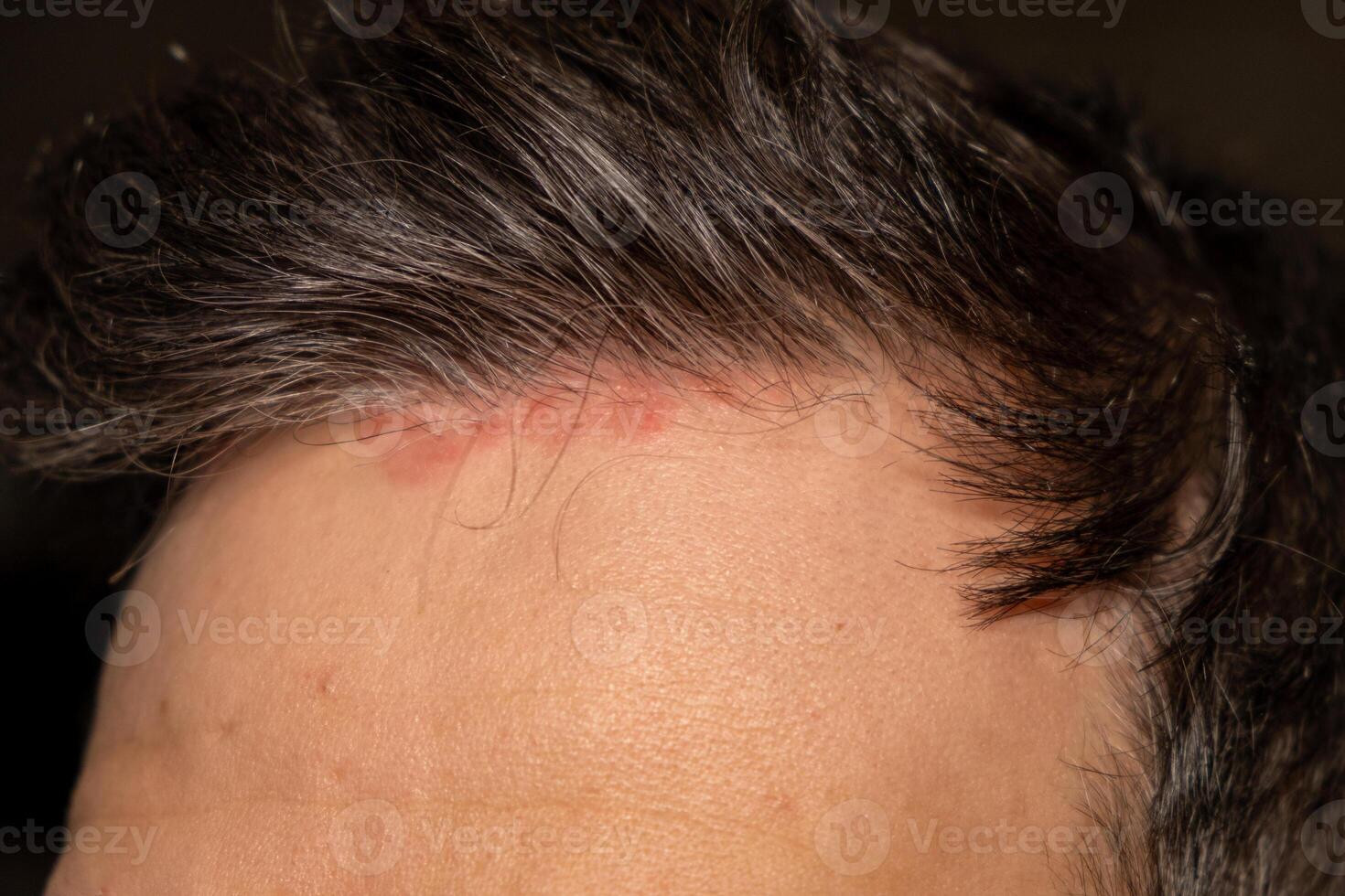 Skin condition showing psoriasis patches on the forehead with visible redness and irritation near the hairline photo