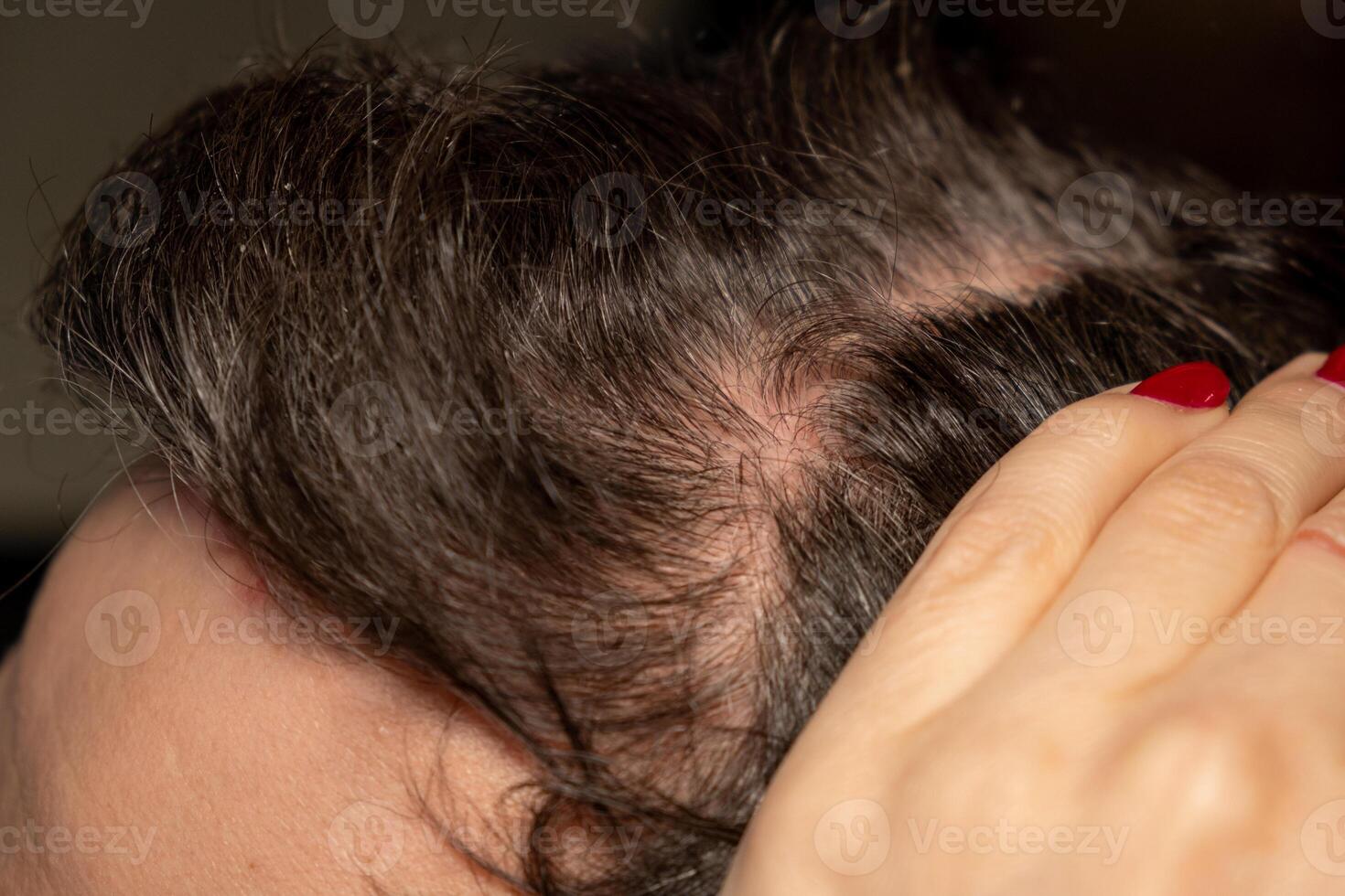Scalp psoriasis characterized by red patches and scaly skin highlighting a common genetic immune condition photo