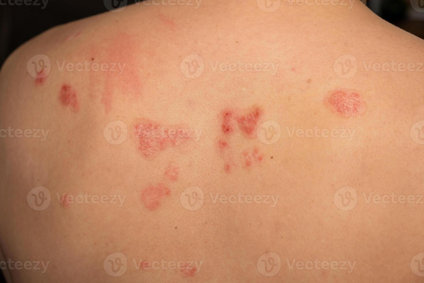 Skin patches affected by psoriasis display red, itchy, and scaly texture on the back of an individual in a clinical setting photo
