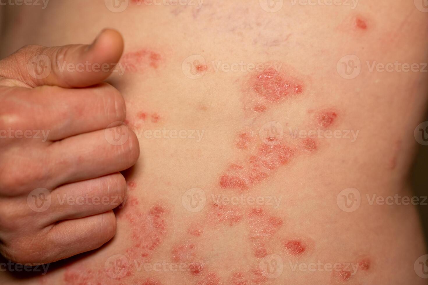 Understanding psoriasis and its effects on skin health in individuals with this genetic immune disease photo