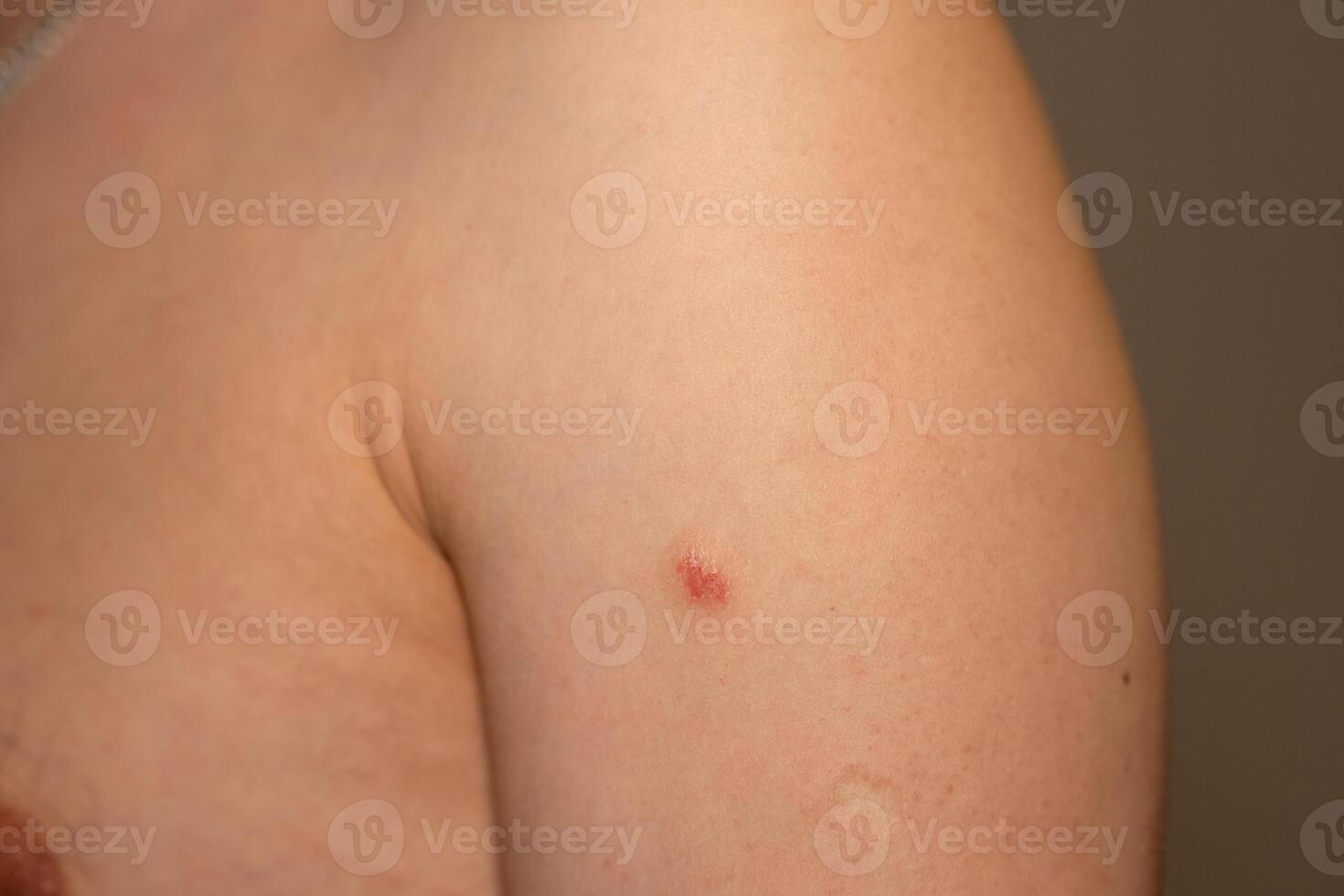 Red, itchy patches on the arm exhibit symptoms commonly associated with psoriasis photo