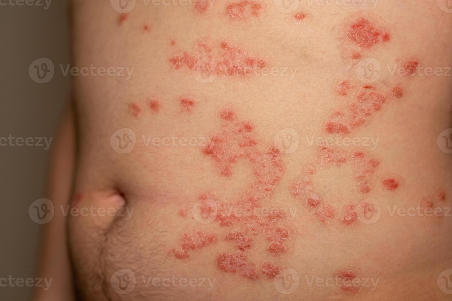 Red scaly patches on skin indicating psoriasis condition affecting the abdomen of an individual photo