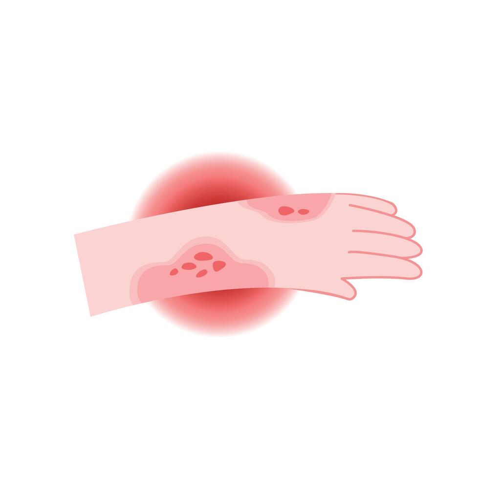 Red rash and itchy on hand cartoon for illustration and health care. Allergy and medical concept vector