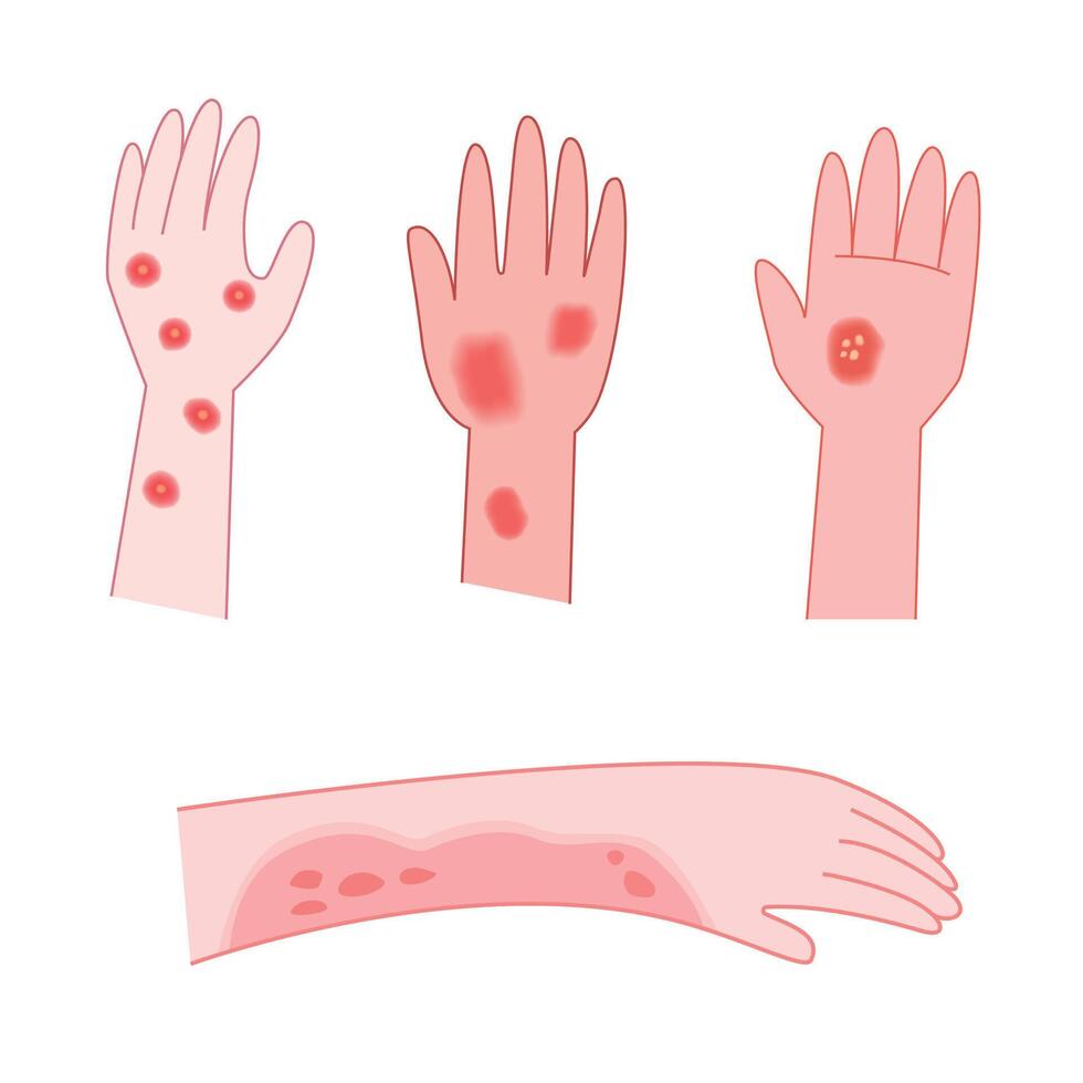 Red rash and itchy on hand cartoon for illustration and medical. Allergy concept vector