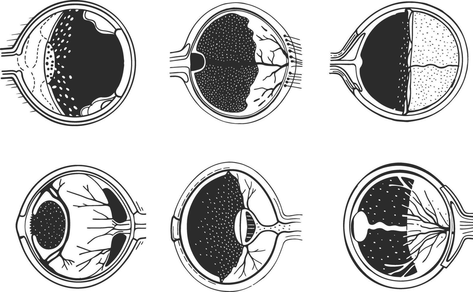 Eye disease illustrations anatomical diagram showing different conditions graphic vector