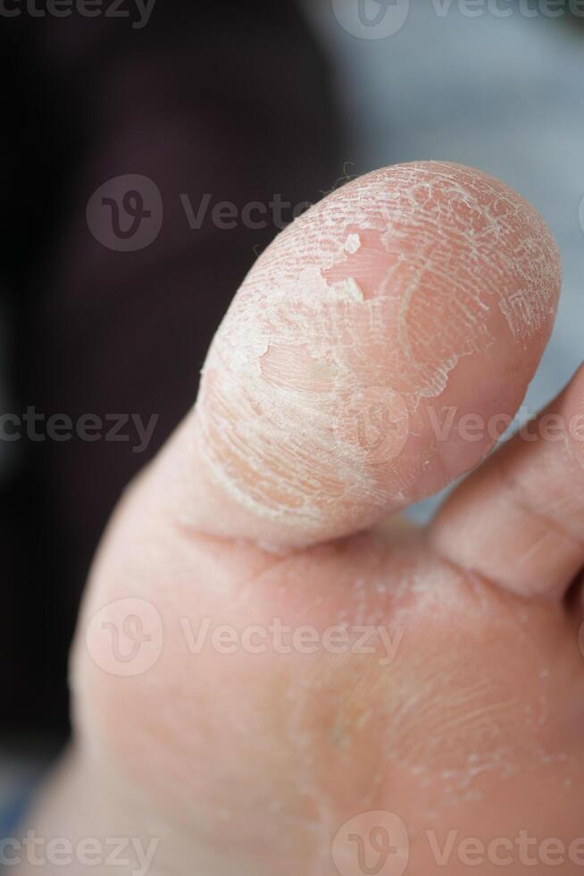 Dry skin on foot captured during a close-up view in natural light photo