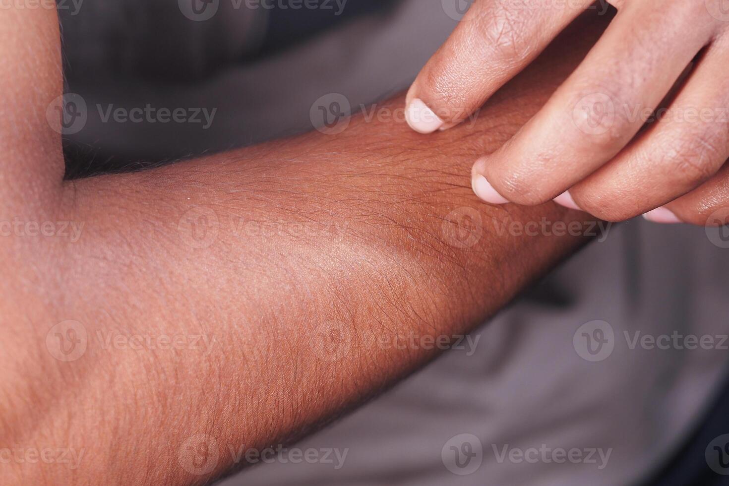 person suffer itching skin on hand closeup photo