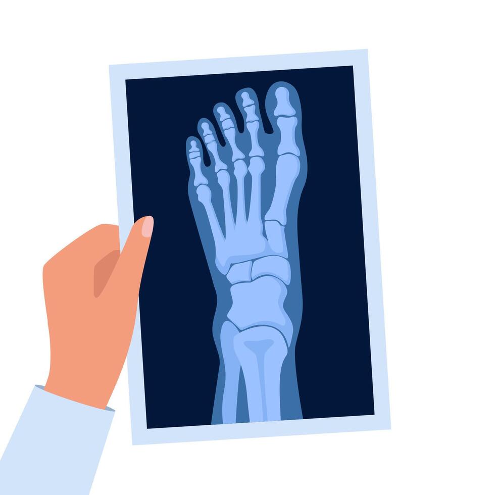 X ray human foot. X-ray picture or radiographic monitor image of metatarsus bones and toes. Medical radiology. Roentgen shot in doctor hand. vector
