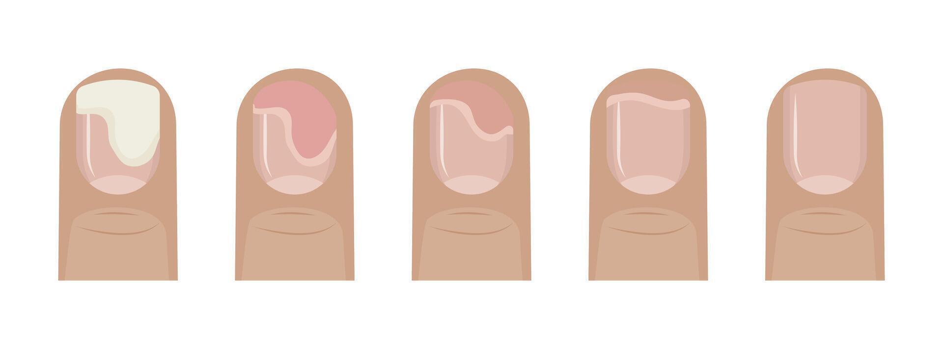 Stages of fingernail treatment showing onycholysis healing process vector