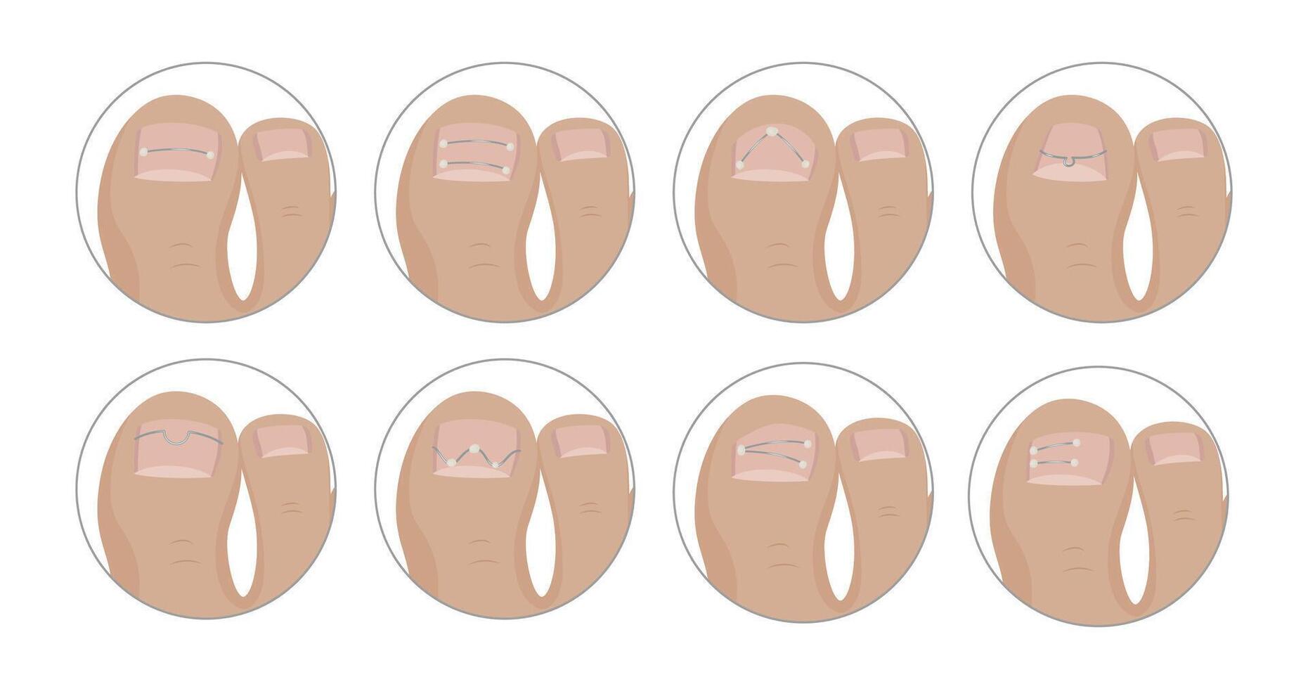 Podiatrist applying different kinds of metallic threads for ingrown toenail correction vector