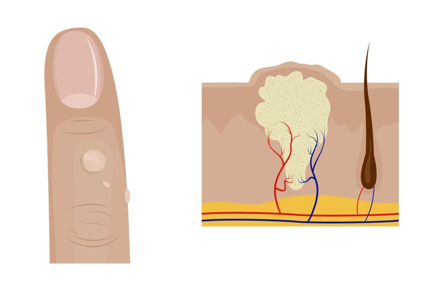 Common warts growing on finger and cross section of wart anatomy vector