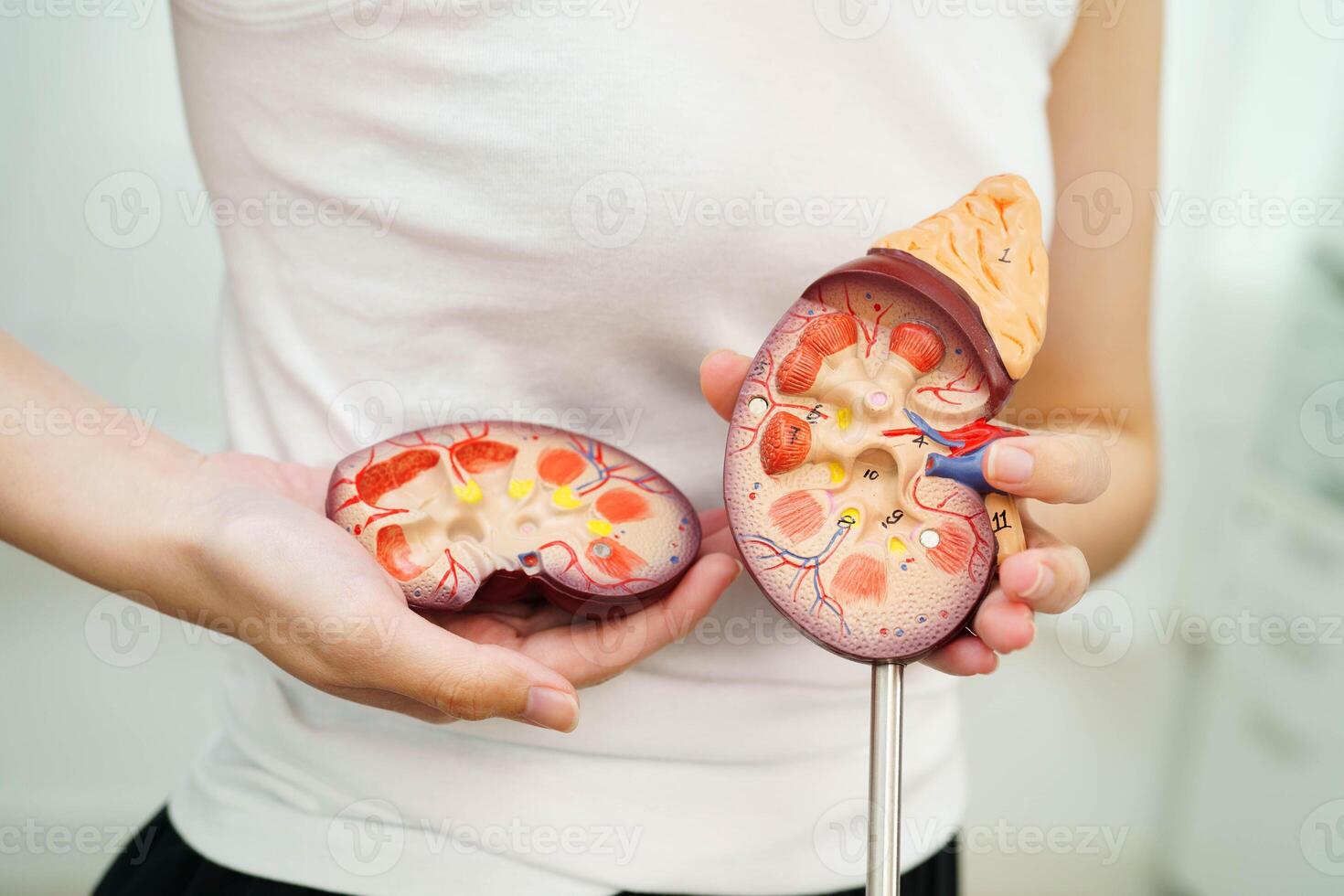 Chronic kidney disease, Asian woman with model for treatment urinary system, urology, Estimated glomerular filtration rate photo