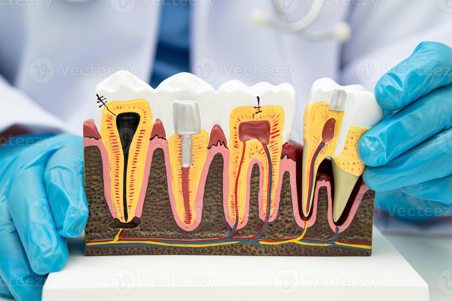 Dental implant teeth photo