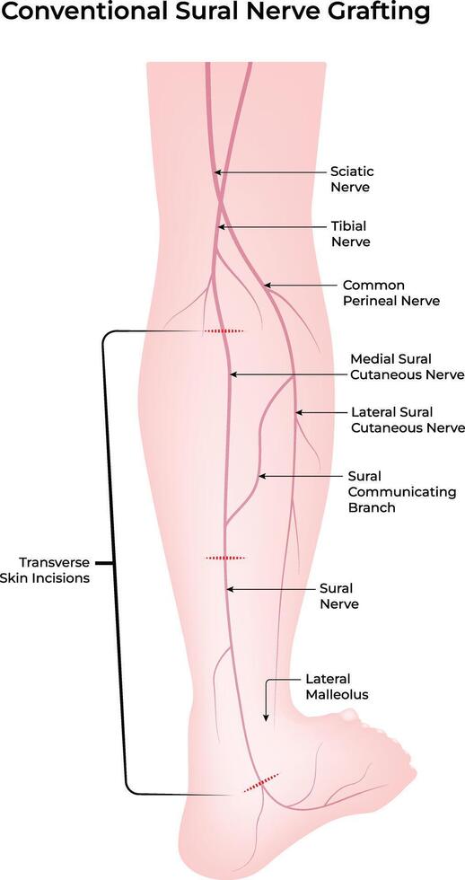 Conventional Sural Nerve Grafting Anatomy and Surgical Approach. vector
