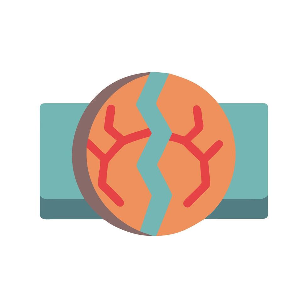 Dry Eye Syndrome Illustration of an Eye Condition vector