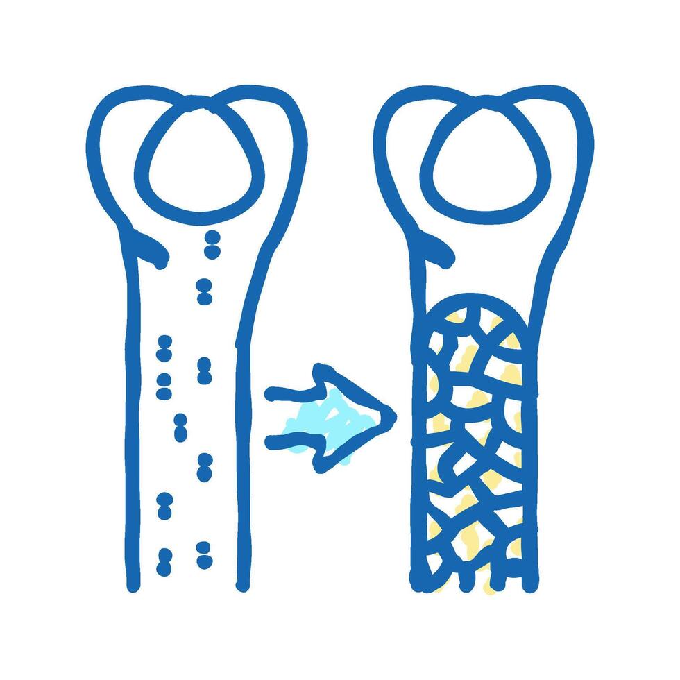 osteoporosis bone disease icon doodle illustration vector