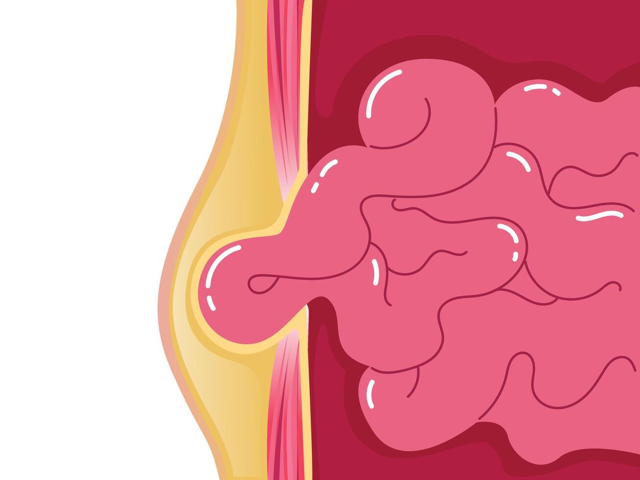 Internal organs abnormal condition, Choked Hernia, Umbilical hernia, Medical poster vector