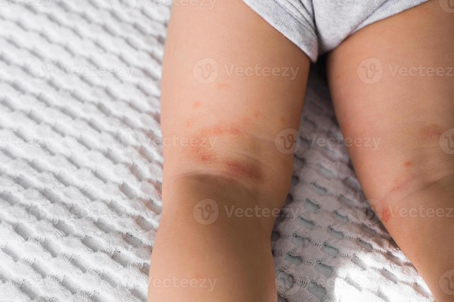 Allergy spots and red itchy skin inflammation on childs feet photo