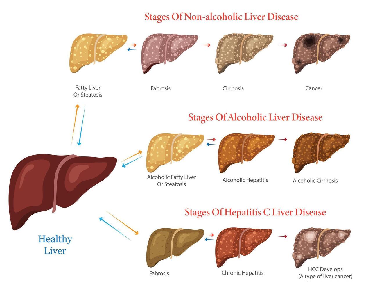 Diagram Illustration Showing Stages of Non Alcoholic Alcoholic and Hepatitis C Liver Disease vector