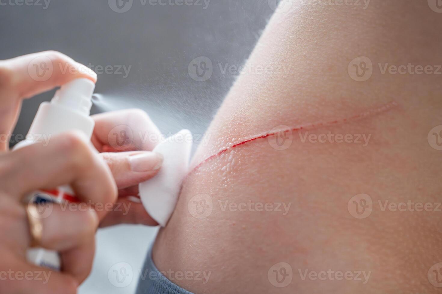 spray antiseptic on the wound on the child's back. disinfection of wounds. hydrogen peroxide spray. Cleaning Flesh Wound With Antiseptic Liquid, Stop Infection photo