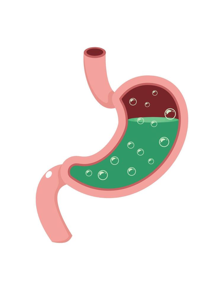 Gastroesophageal reflux disease. GERD stomach acid isolated on white background vector
