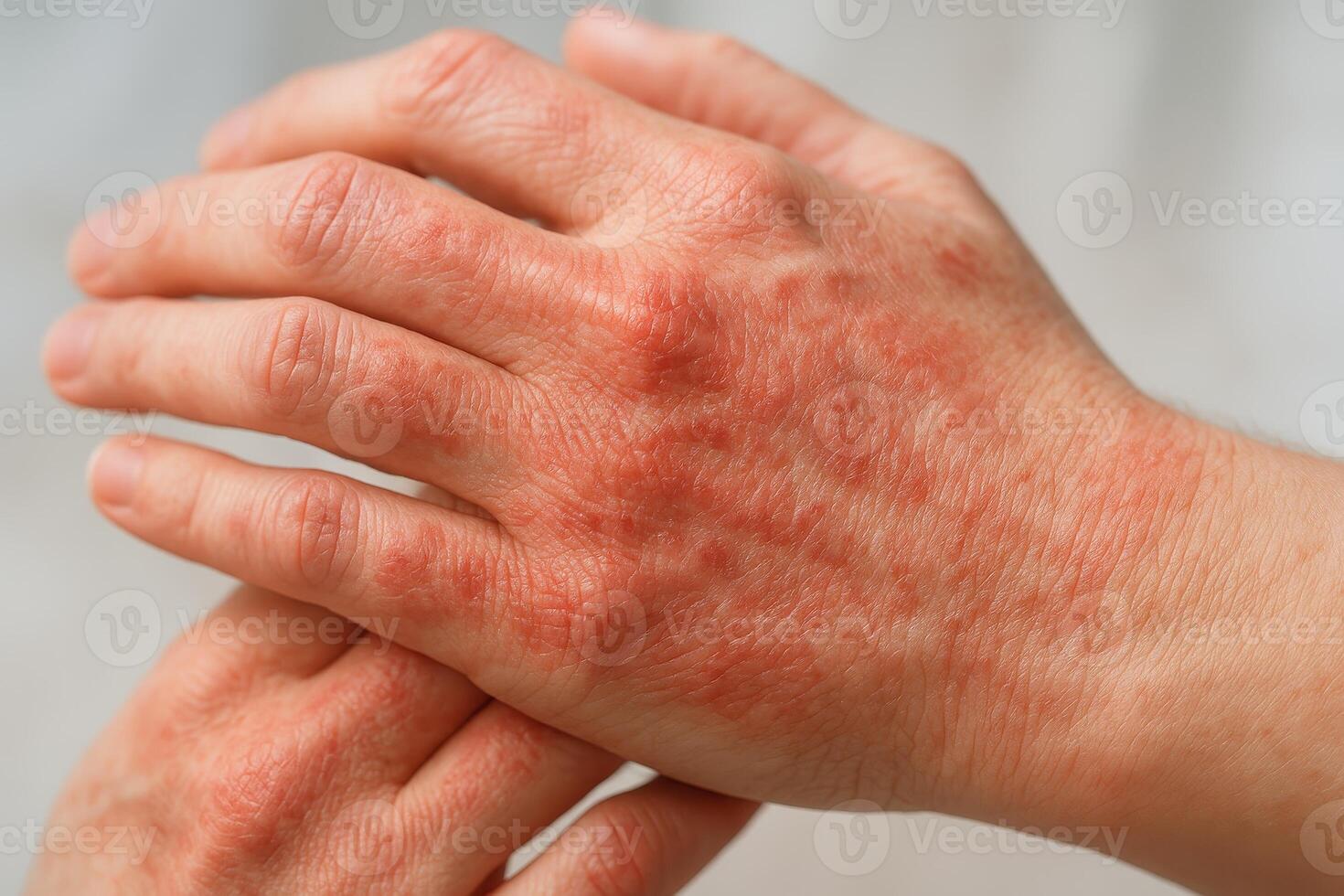 A close-up of irritated, red skin on hands, indicating eczema or dermatitis symptoms with dry patches and inflamed texture photo