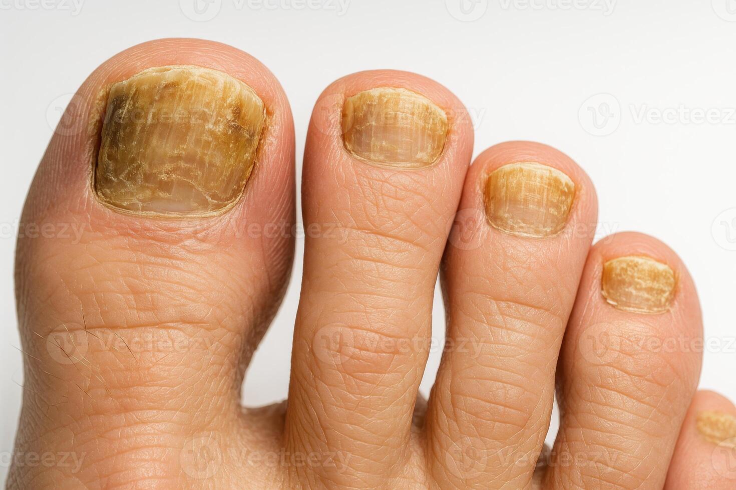 A close-up of toenails affected by fungal infection, showing discoloration, thickening, and nail surface damage caused by onychomycosis photo