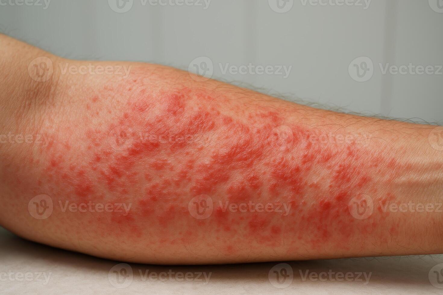 A red inflamed rash covers a forearm, indicating irritation, allergy, or possible dermatological condition requiring medical attention photo