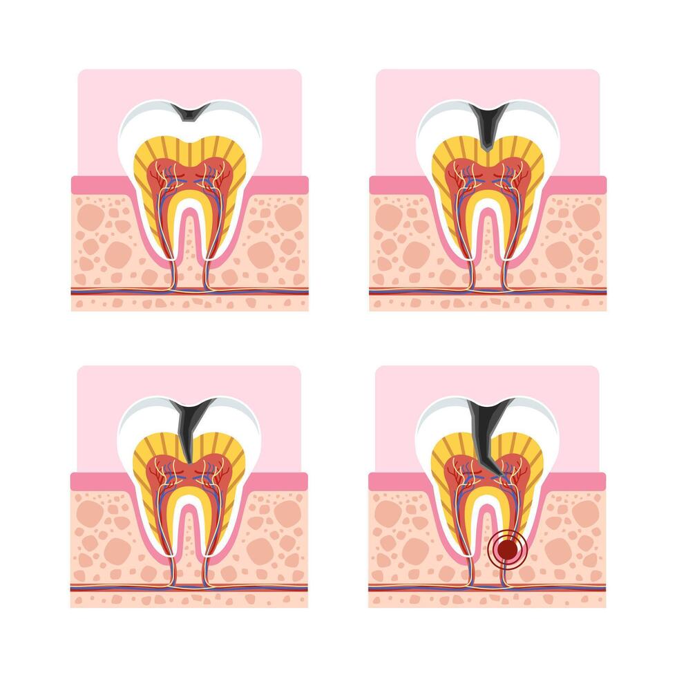 Tooth decay 4 stages cross section showing cavity development from enamel to pulp infection for dental education. vector