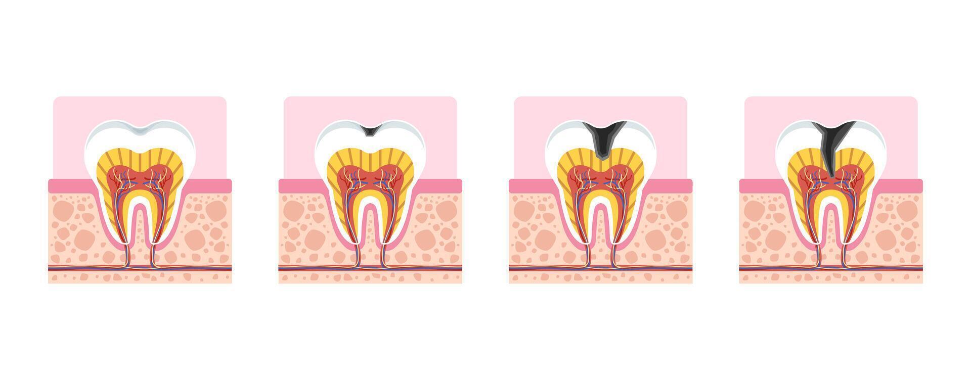 Tooth decay progression stages cross section for dental education, showing enamel damage, dentin exposure, and pulp infection. vector