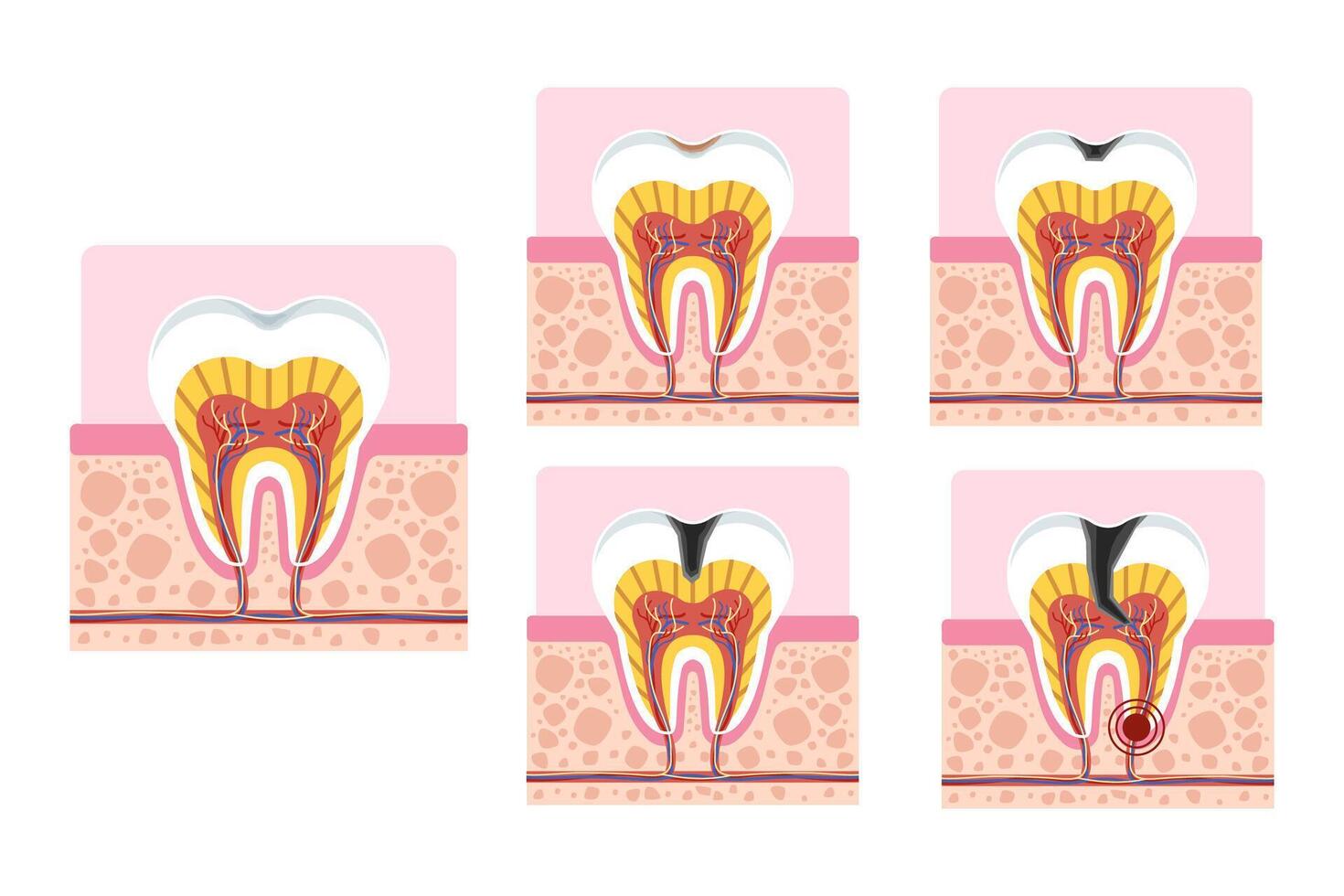 Stages of tooth decay showing enamel, dentin, and pulp involvement. Dental health illustration. vector