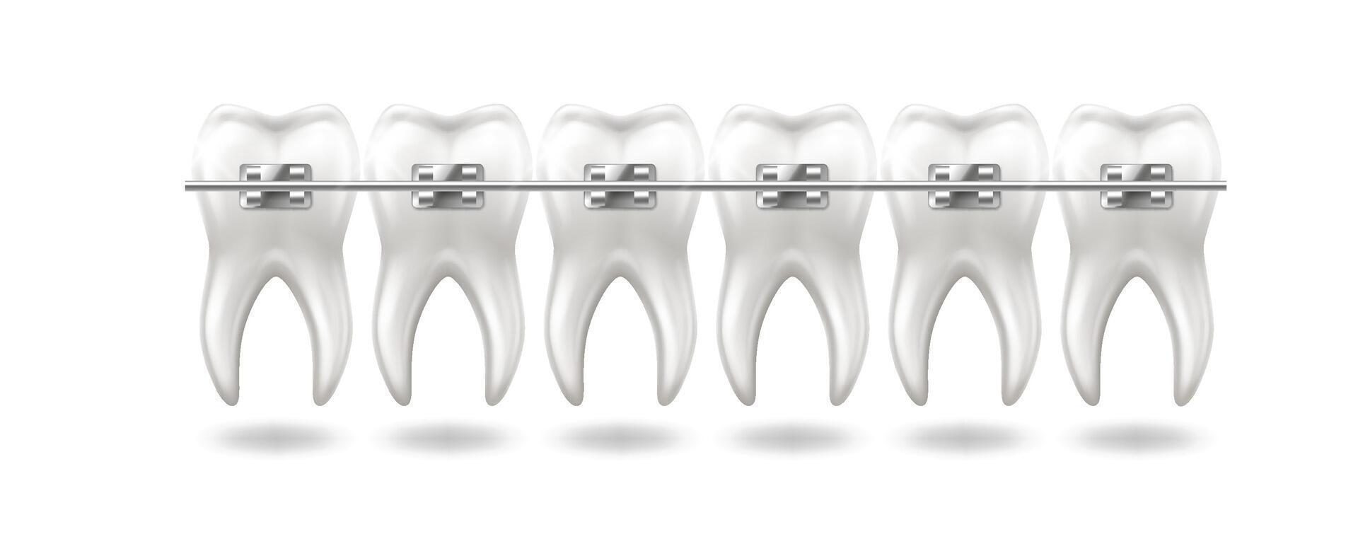 Illustration showing white teeth with metal braces for orthodontic treatment on white background. Ideal for dental care and orthodontics promotions demonstrating teeth alignment with copy space. vector