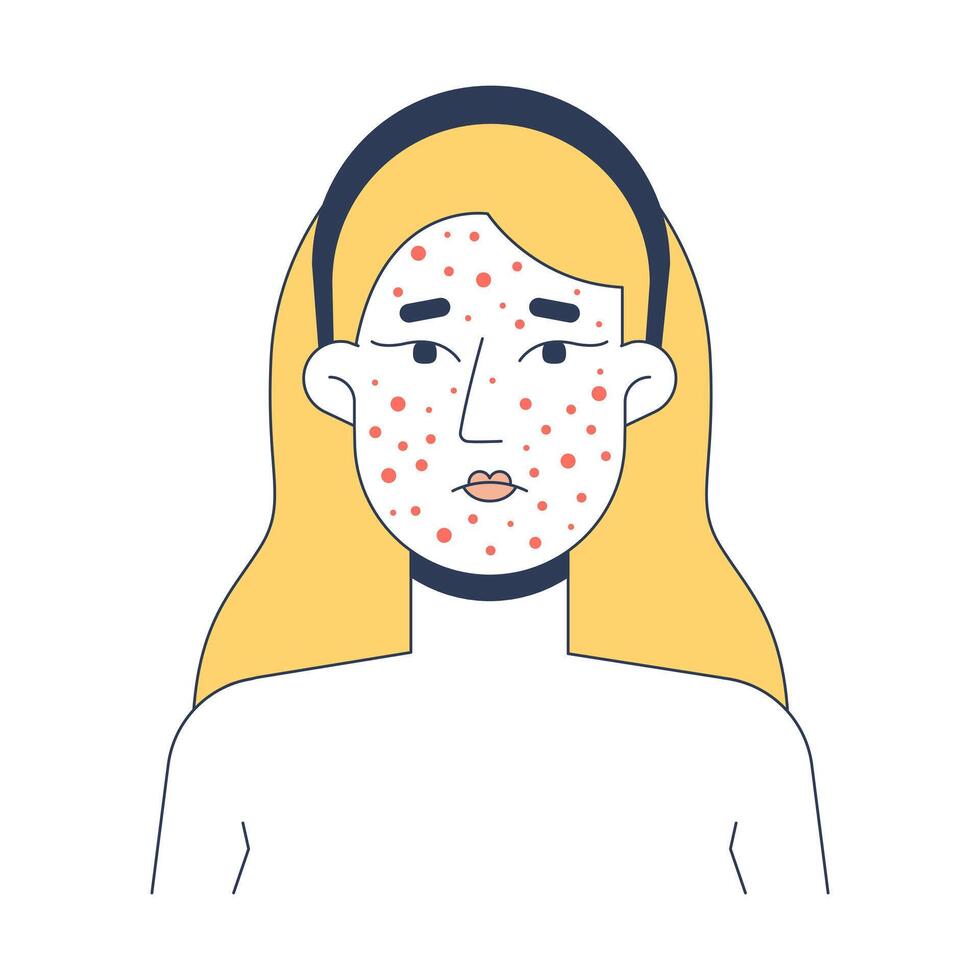 Blonde woman acne breakout skin problem 2D illustration. Rosacea facial rash. Caucasian white female face pimples irritation flat character isolated on white background. Colorful cartoon image vector